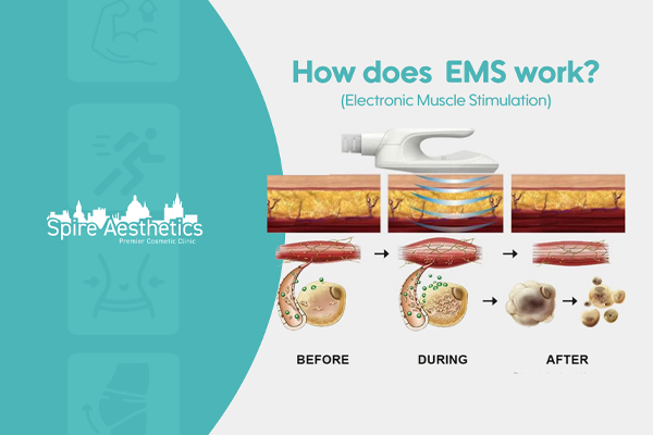 EMS treatment for post pregnancy weight loss treatment Hatfield
