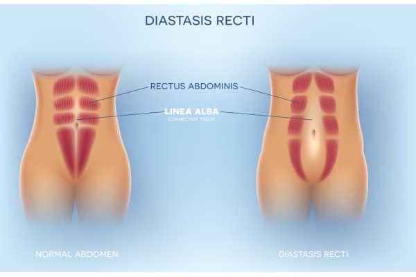 What Non-Surgical Options Are Available for Diastasis Recti Hatfield?