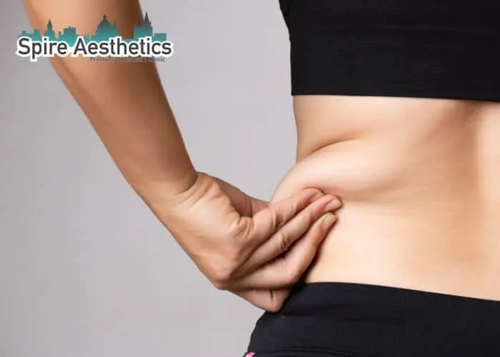 Image of woman pinching fat on their hips Hatfield. Fat Freezing treatment