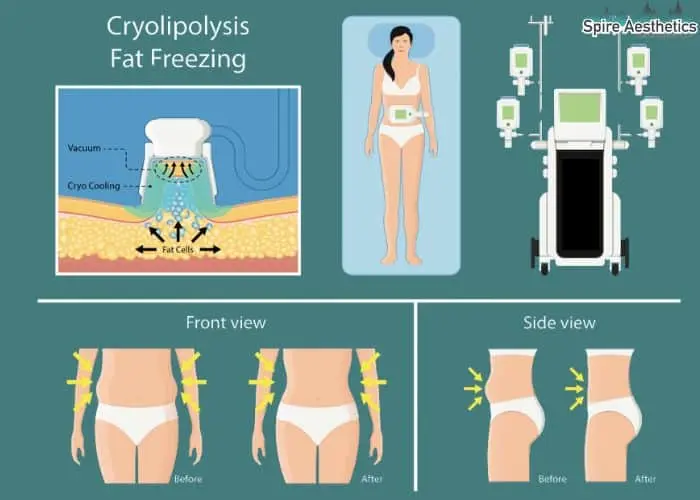 Fat freezing treatment Hatfield benefits for competitions to remove stubborn fat deposits.