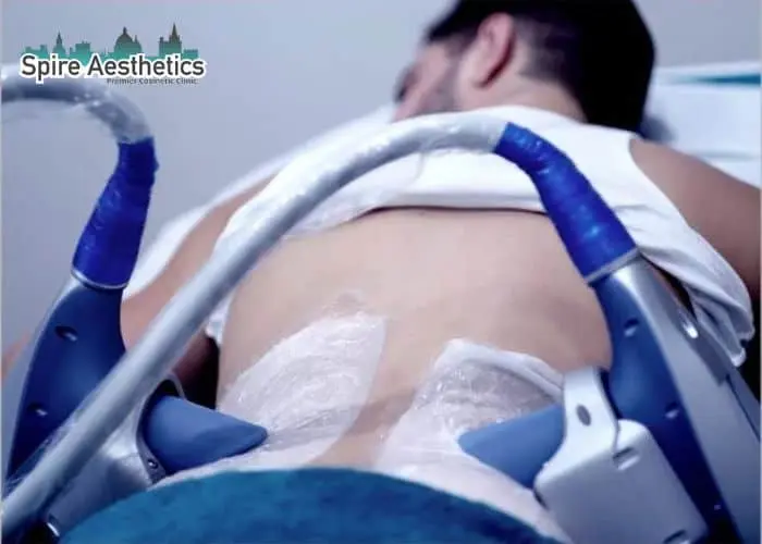 Man having fat freezing treatment done on love handles before a competitions Hatfield to create a sculpted look.