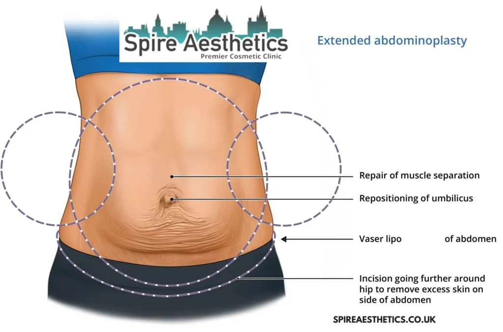 Understanding Loose Skin After Gastric Band Hatfield Surgery and HIFU Treatment