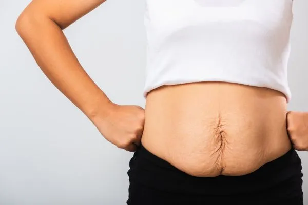 Image of a woman's stomach after weight loss with sagging skin following a gastric band Hatfield