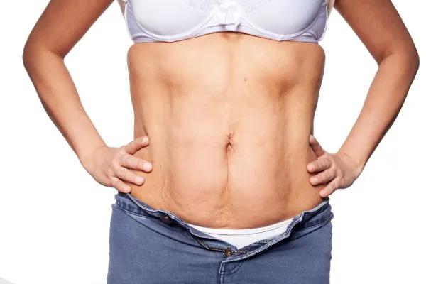 sagging skin on woman's stomach after weight loss injections Hatfield