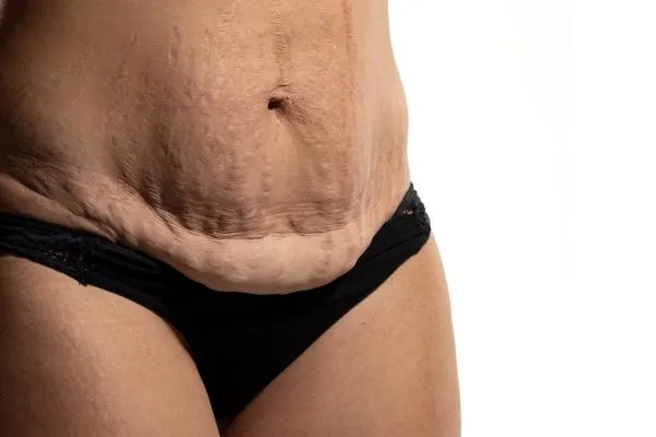 Image of womans stomach after weight loss injections Hatfield showing saggy skin