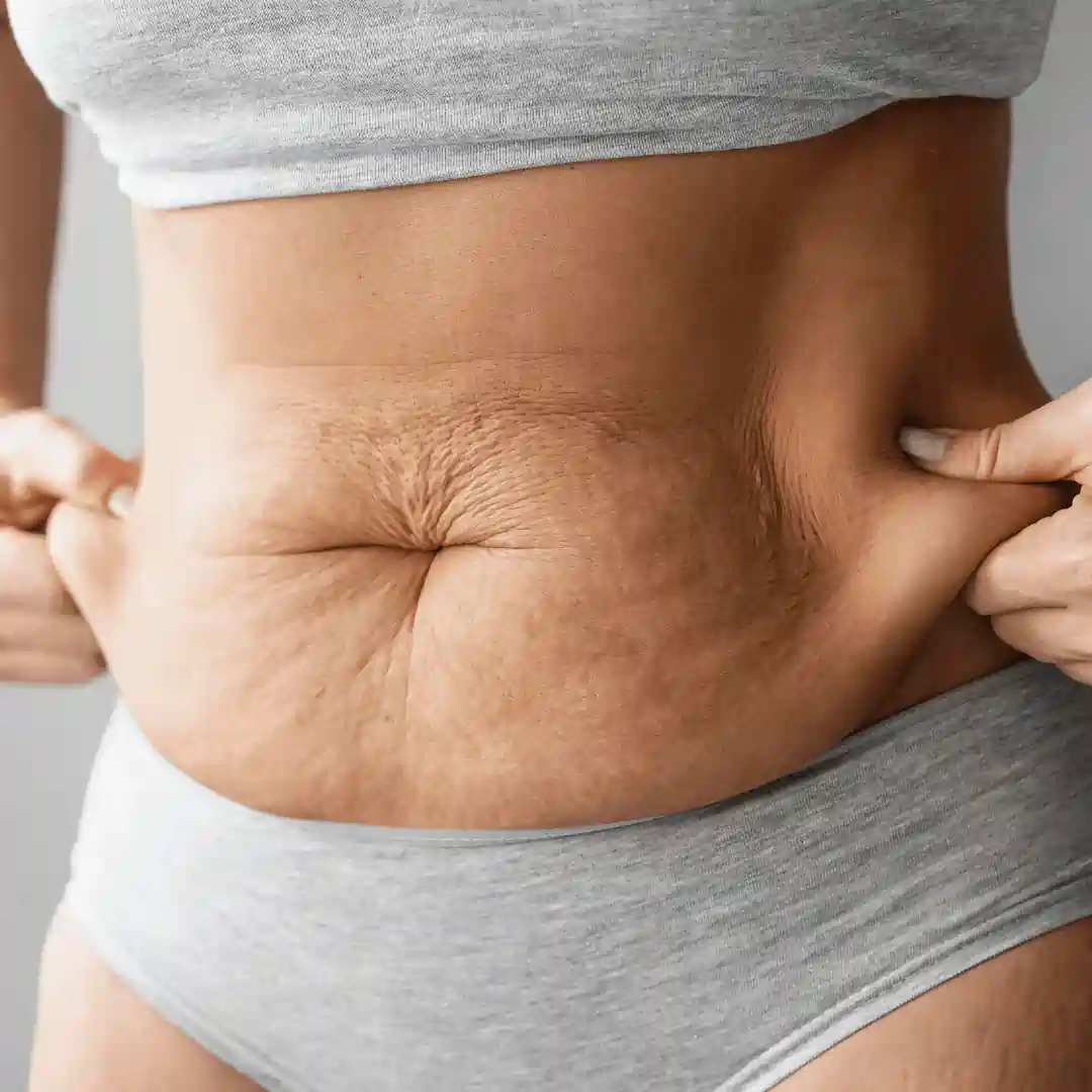 Is It Normal to Have Loose Skin After Pregnancy Hatfield?