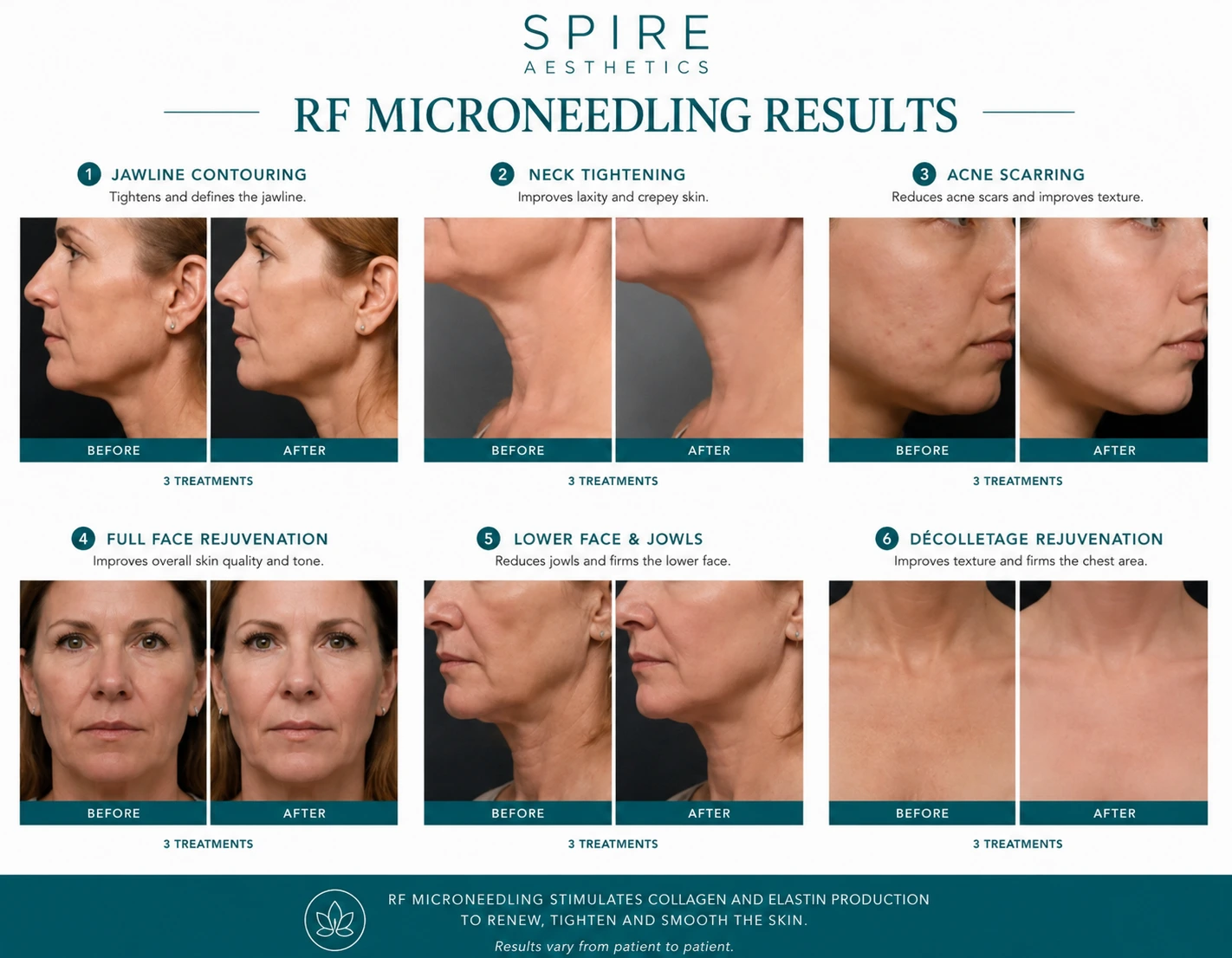RF Microneedling Skin tightening Hatfield results