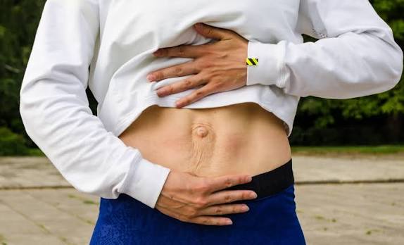When Could Diastasis Recti Be the Missing Piece of the Puzzle Hatfield?