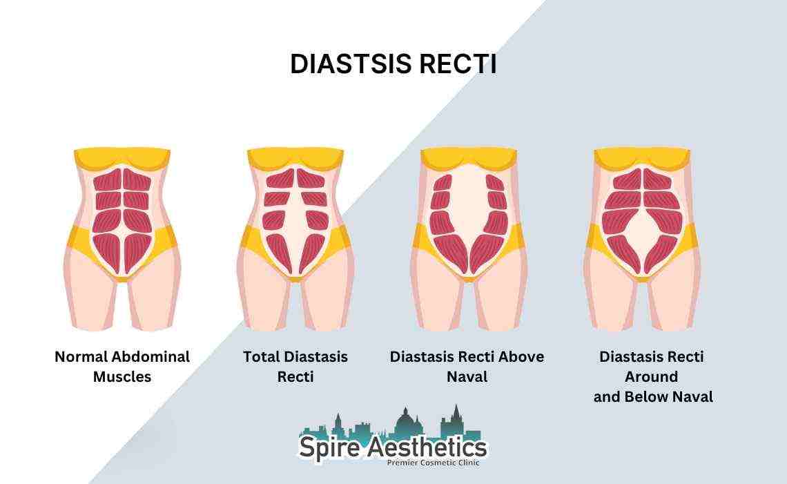 Is Non-Surgical Diastasis Recti Treatment Right for You? Common Concerns Answered Hatfield